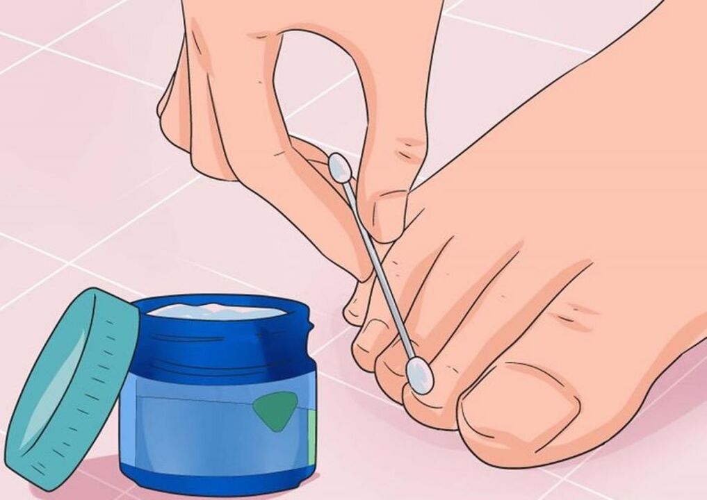 application of ointments to treat nail fungus