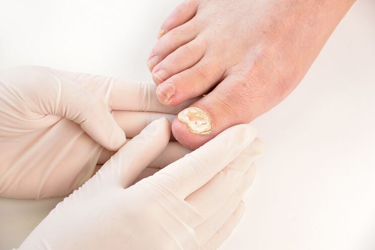 Before prescribing treatment, the doctor should diagnose toenail fungus