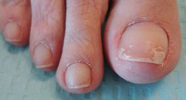 One of the symptoms of onychomycosis is separation of the nail plate. 