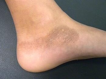 Mycosis of the feet is accompanied by a change in the color of the skin