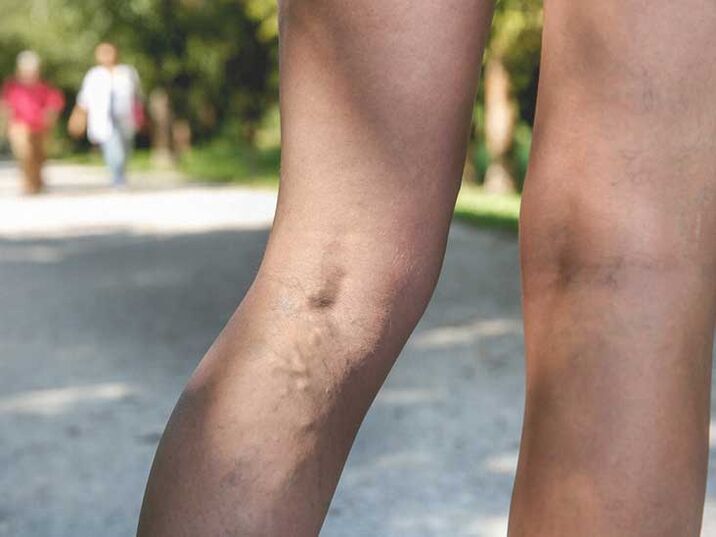 Varicose veins are a risk factor for fungal foot infection