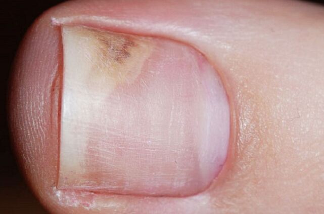 Signs of onychomycosis in the initial stage - lack of shine, gap between the nail and the bed