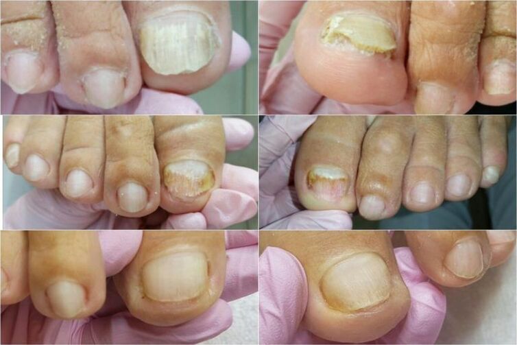 signs of nail fungus