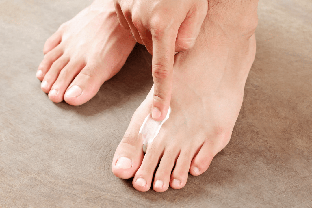 applying antifungal ointment to the skin of the feet