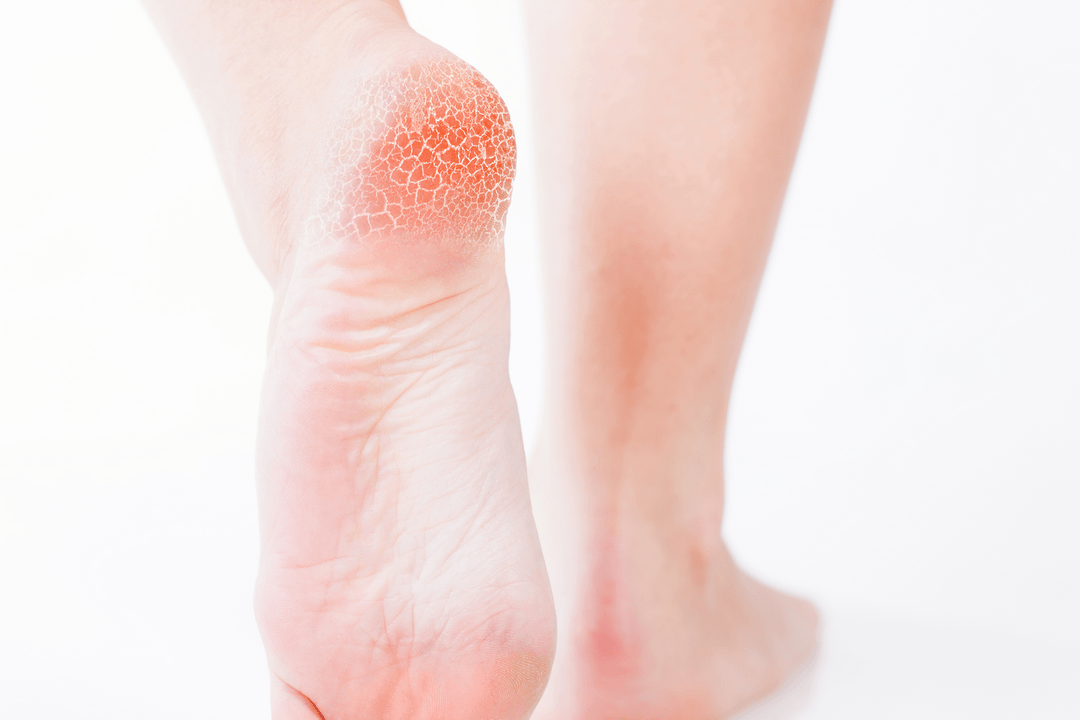 treatment of foot fungus at an early stage