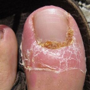 Fungus nail