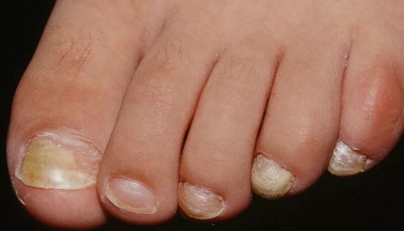 Fungi nails on the thumb