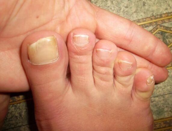 Fungus on a large nail