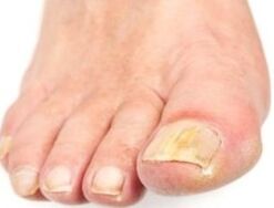 After bath, the affected nail is easier to remove