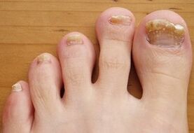 Injected ofychomycosis