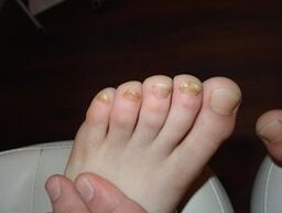 Nail Fungus happens even in children