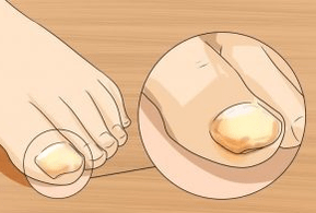 Fungus nail