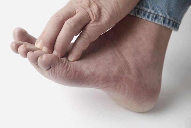 Fungus feet