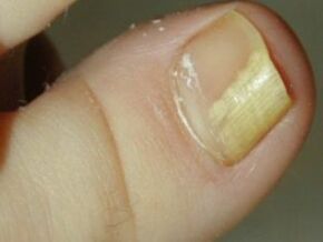 Fungus nail