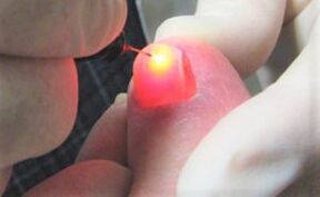 Healing Fungus Treatment with Laser