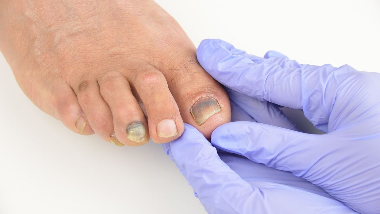 Inspection Fungal Foot