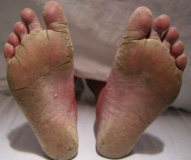 Mycotic defeat of legs