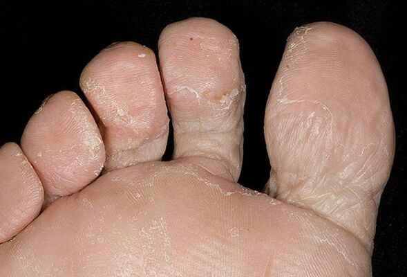 Types of Fungus Leg