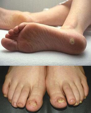 Fungi on your feet