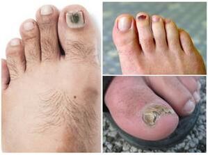 Fungus nail