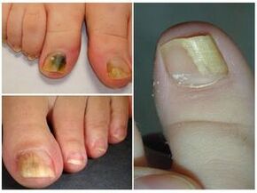 What does the nail fungus look like