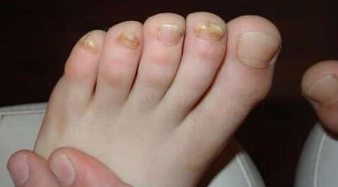 Almost all fingers are influenced by mushrooms