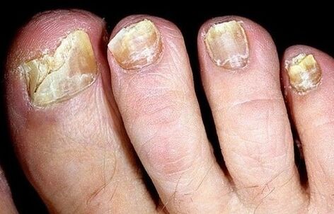 Nails are falling apart from the fungus