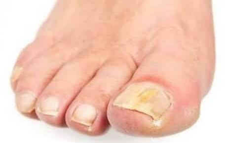 Stage phase of fungi on foot nails
