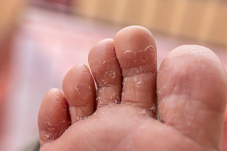 Fungus between the fingers