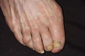 Handling fingers for nails on the legs cider vinegar