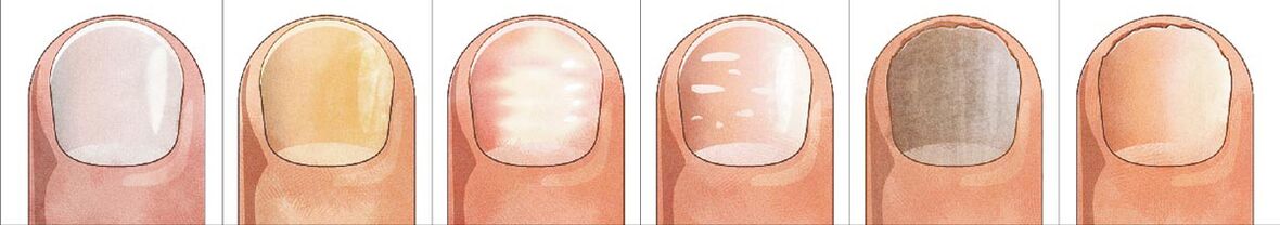 How nail fungus occurs