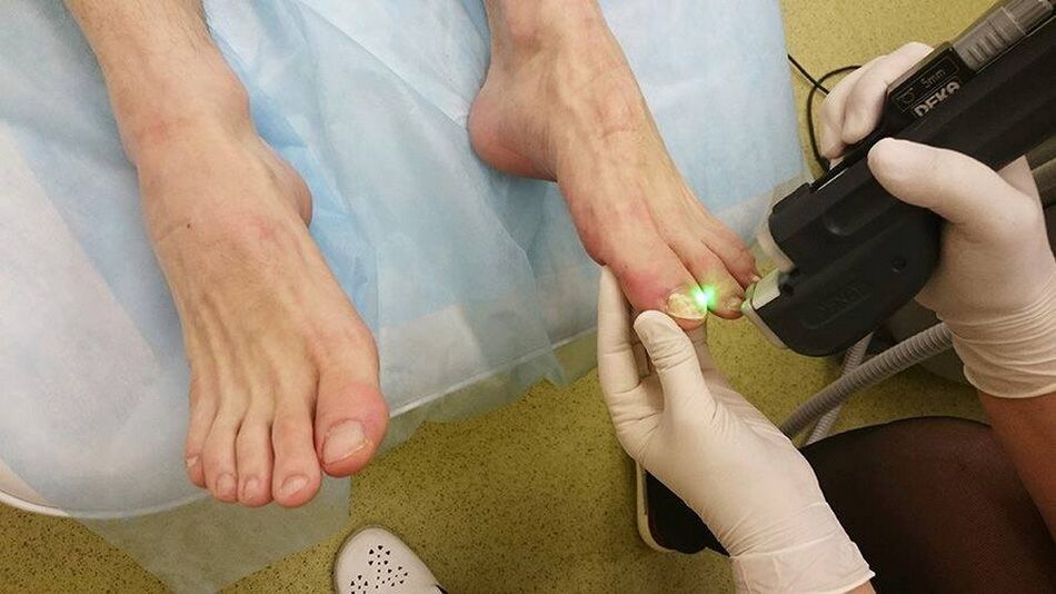 laser therapy of nail fungus