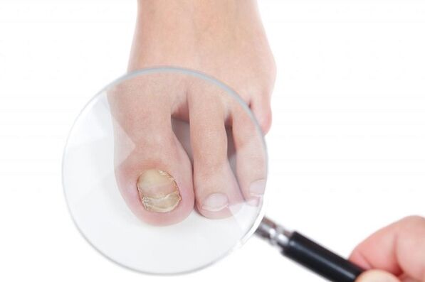 stages and stages of toenail fungus development