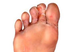 fungus between the toes
