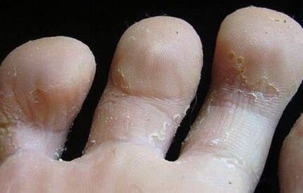 signs of fungus between the toes