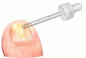 Applying medicinal drops to the nail affected by the fungus