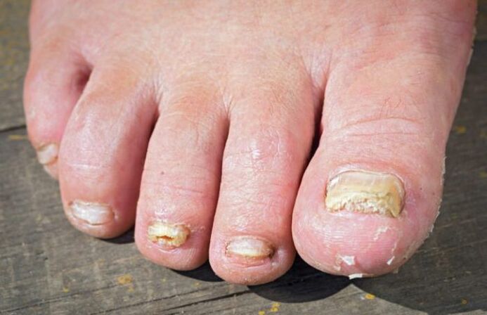 Rubromycosis fungi on the feet