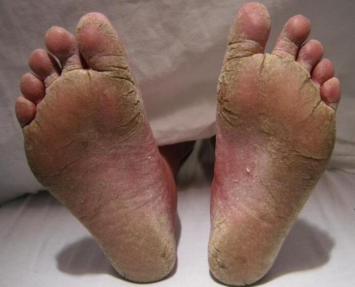 squamous-hyperkeratic fungi on the legs