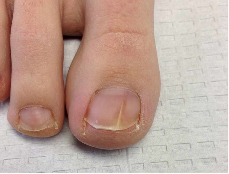 Streaks and spots on the toenail during the first stage of fungal development