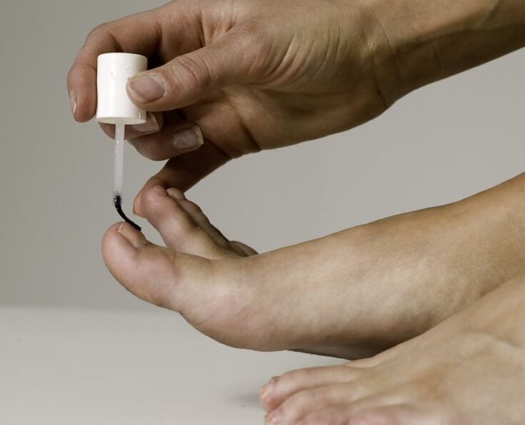 The use of medical varnish for the treatment and prevention of onychomycosis on the big toe