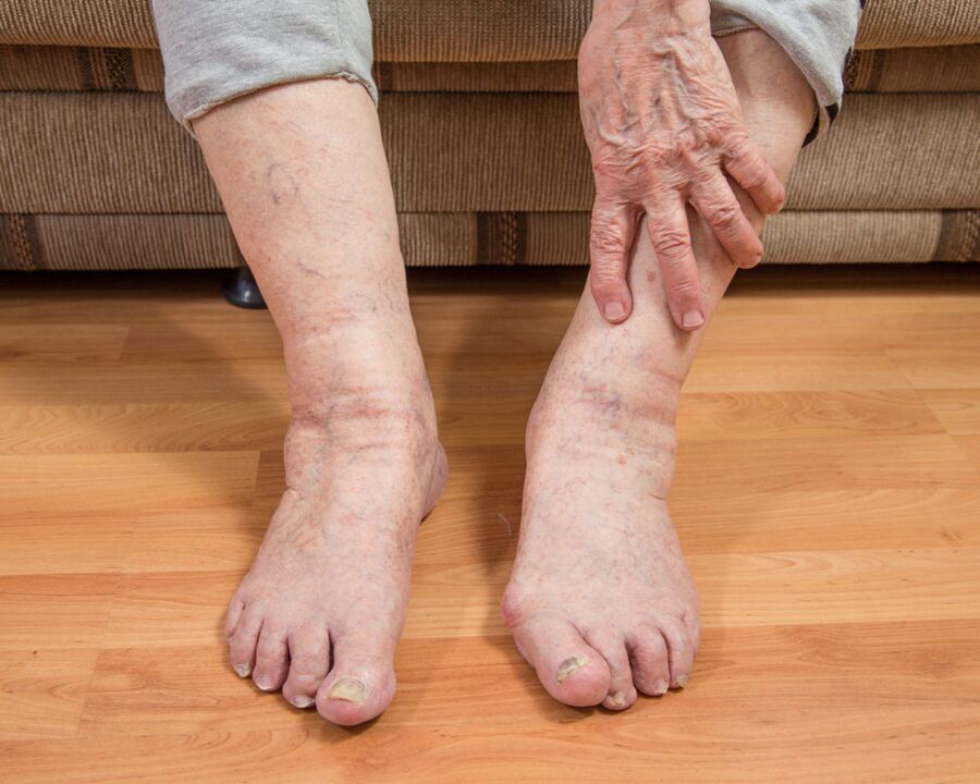 To avoid the spread of fungal microspores, do not walk barefoot at home.