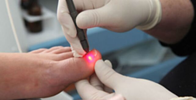 Laser therapy of toenail fungus